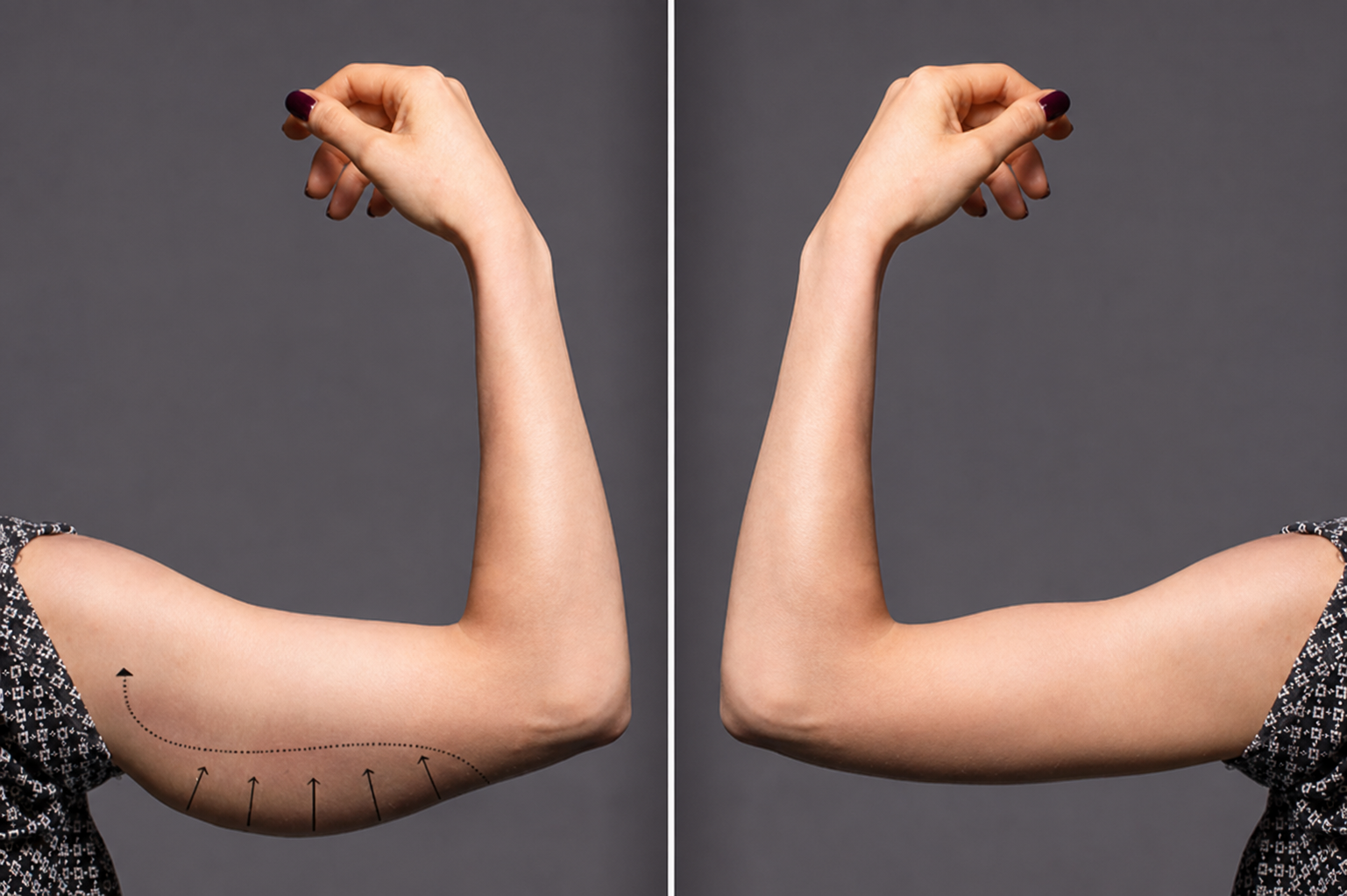 Contorno corporal y lipoaspiración